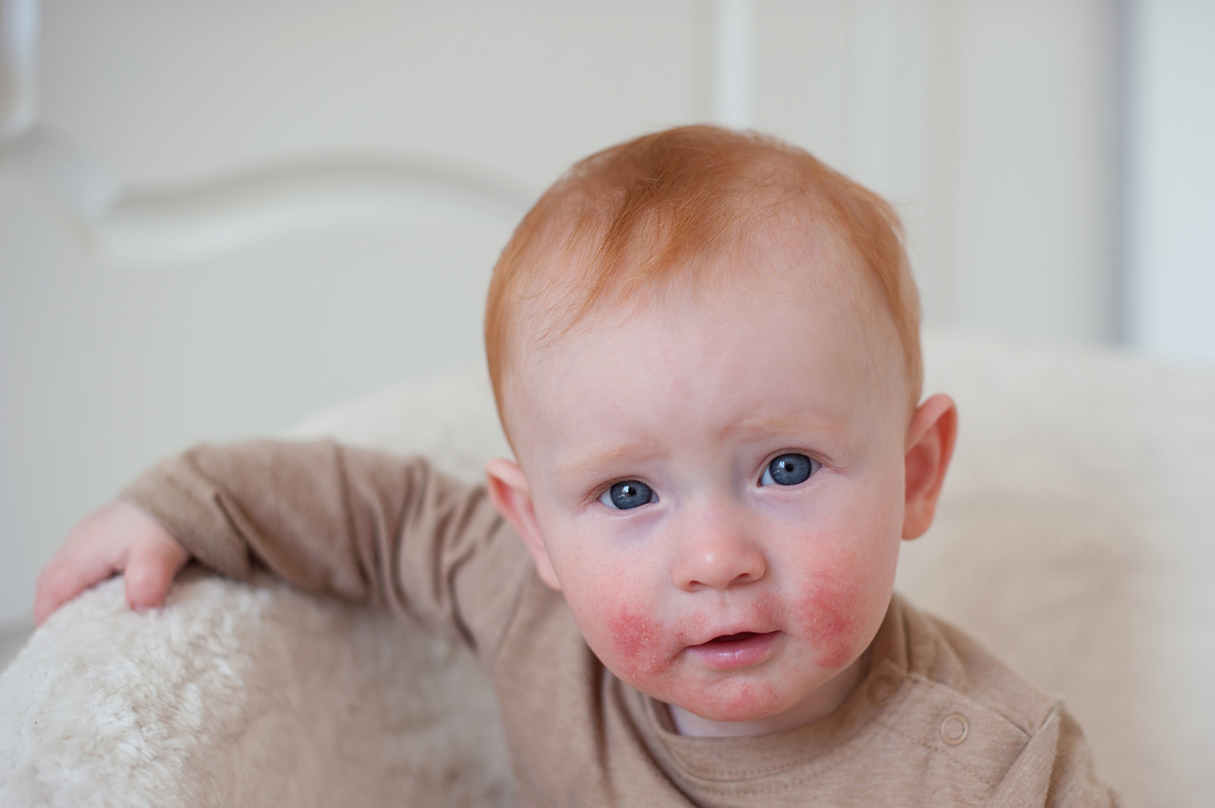 Baby with atopic dermatitis